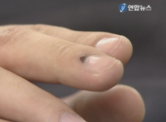 몸에 멍 드는 이유도 가지가지