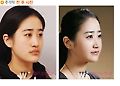 양악수술, 잘못된 상식과 진실?